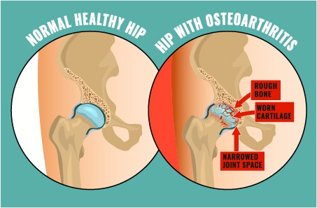 hip-with-Osteoporosis