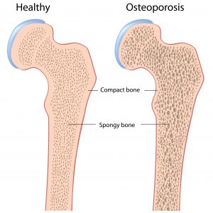 Osteoporosis-bone-density